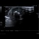Thickening of nail bed, ultrasound of nail: US - Ultrasound